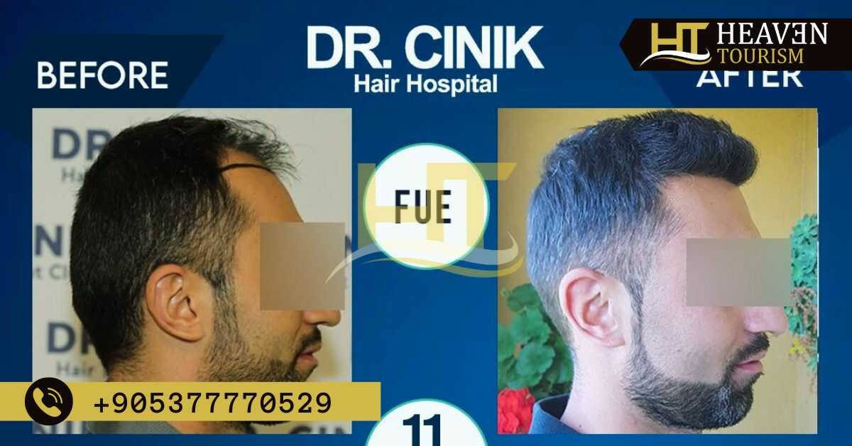 احسن مركز لزراعة الشعر في تركيا