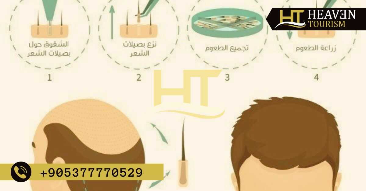 تكلفة زراعة الشعر في تركيا بالدرهم المغربي